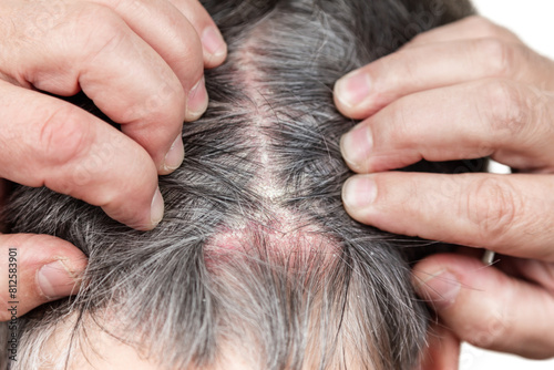 psoriasis.Psoriasis psoriatic skin disease in head hair, skin patches are typically red, itchy, and scaly.