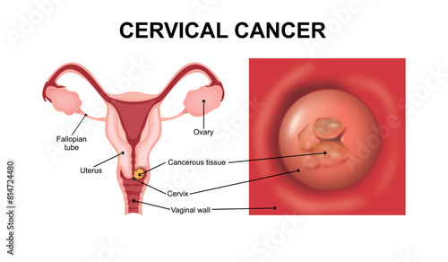 Cervical cancer illustration Vaginal cancer