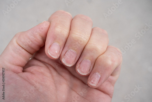 Regrown nail cuticle and damaged nail plate after gel polish. Flaky brittle nails without a manicure.