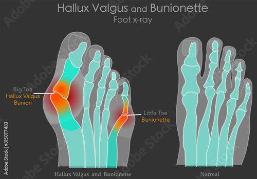 X-ray, roentgen sample. Top foot x ray big toe symptom structure. Orthopedic patients surgery. Bunion, hallux valgus anatomy. Foot bones, joint deformity feet. Illustration medical vector