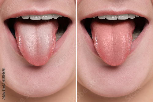 Woman showing her tongue before and after cleaning procedure, closeup. Tongue coated with plaque on one side and healthy on other, collage