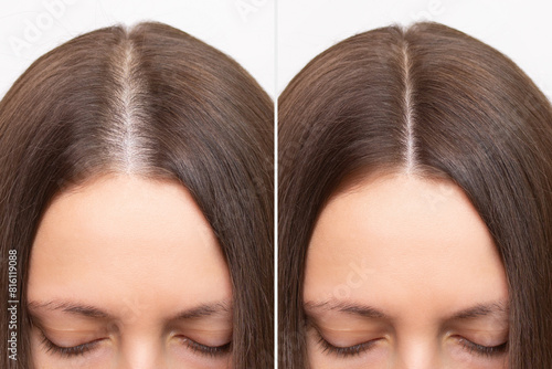 Before and after head shot of a young woman with a receding hairline on her forehead and parting. Baldness. Close-up, front view. Hair care and treatment concept. Hair loss, hair transplant, alopecia