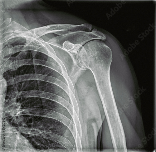 X-Ray Radiography of an injured left shoulder