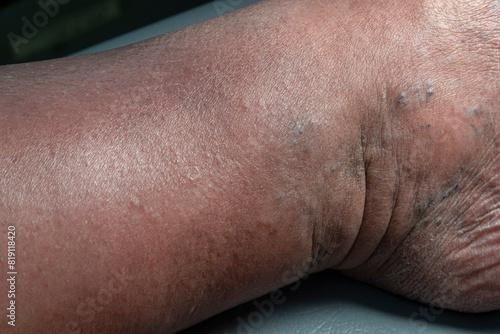 Medical themes: Female senior patient with skin changes caused by venous stasis. Sclerodermiforms