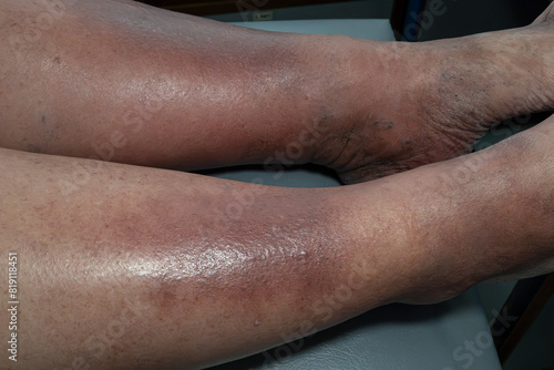 Medical themes: Female senior patient with skin changes caused by venous stasis. Sclerodermiforms