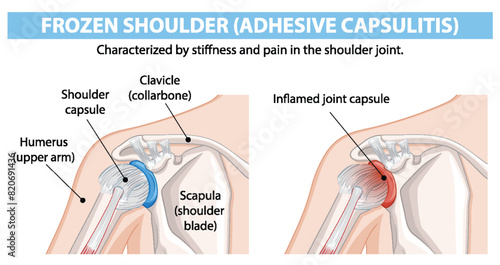 Diagram showing frozen shoulder anatomy and inflammation
