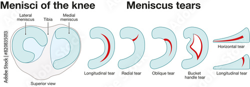 Meniscus tears of the knee joint. Anatomy, injury. Labeled Illustration