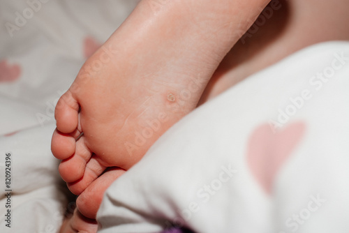 Close-up of an extensive wart on a child's foot