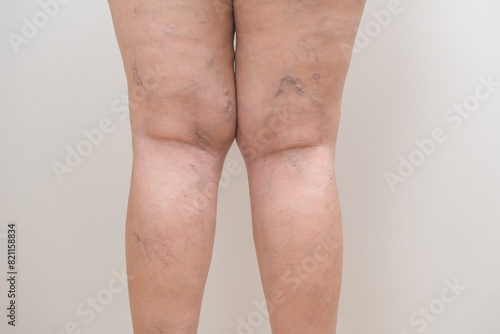 Health care beauty, varicose veins on skin of leg, woman showing vascular, thrombosis on legs isolated on background. Vascular disease, varicose vein problem. Treatment with medicine and cosmetology.