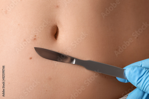 Surgeon with scalpel and moles on woman's belly, closeup