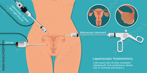 Laparoscopic surgery for treatment fibroids and cysts in the uterus.