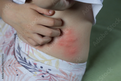 Red, swollen and itchy spots on skin caused by insect bites or allergy. Skin reaction to insect bites.