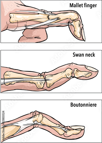 Common Finger Injuries vector illustration