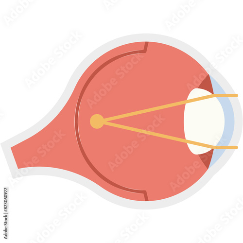 Myopia Illustration