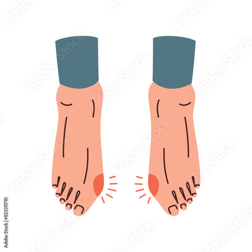 Feet with bunion, orthopedic condition, problem with feet, bone deformity, hallux valgus vector illustration, barefoot shoes brochure, high heeled narrow shoes health risks, redness and inflammation