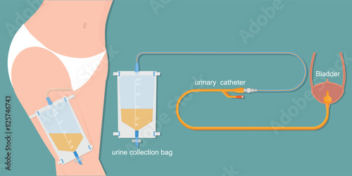 Urinary catheter in the female body with urinary leg bag.