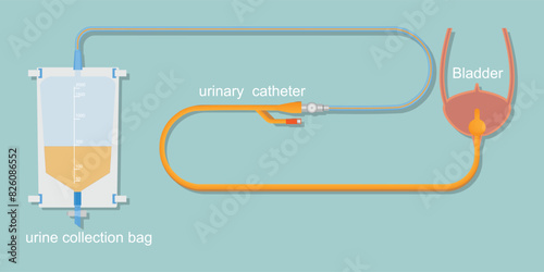 Urinary catheter in the body with urine drainage bag isolated on background.