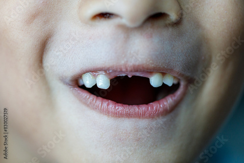 Close up image of the mouth of a little boy who just lost her two front teeth. New teeth are growing in where the old ones have fallen out