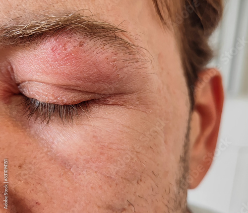 Eyes of a man suffering from herpes zoster on the 7th day of illness. inflamed eyelid and eye and forehead blisters during herpes disease. shingles on the face