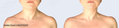 front of neck and shouledrs before and after botulinum toxin.