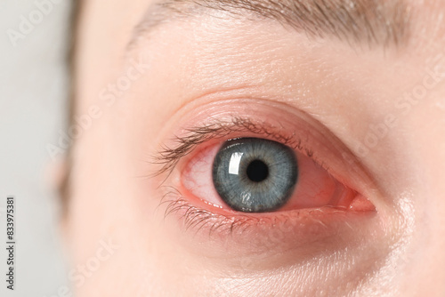 Woman with red eye suffering from conjunctivitis on light background, closeup