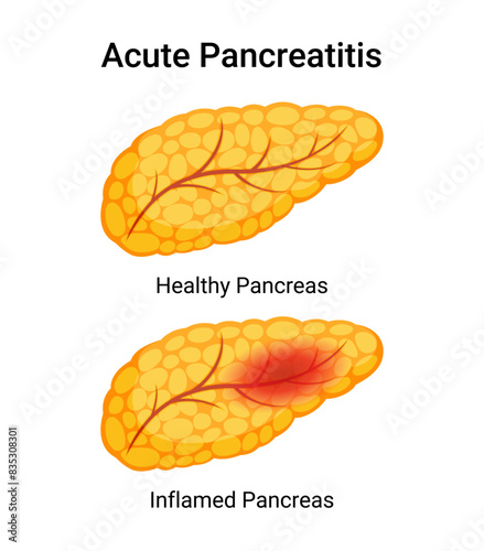 Symptoms of Acute Pancreatitis healthy and inflamed pancreas