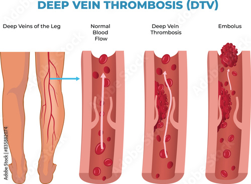 illustration of deep vein thrombosis diagram, DVT