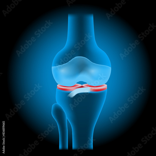 Knee meniscus injuries. knee joint anatomy