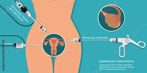Laparoscopic fibroid removal is a minimally invasive procedure to remove uterine fibroids.