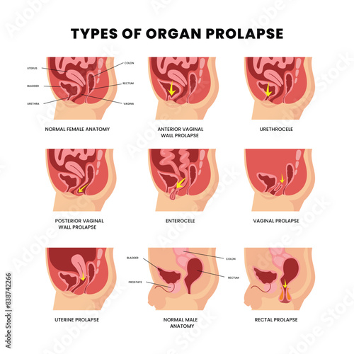 Set different types of organ prolapse diagram scheme infographic poster, uterus disorder Pelvic floor prolapse type uterine biofeedback treatment stage degree cystocele, uterine prolapse, rectocele.