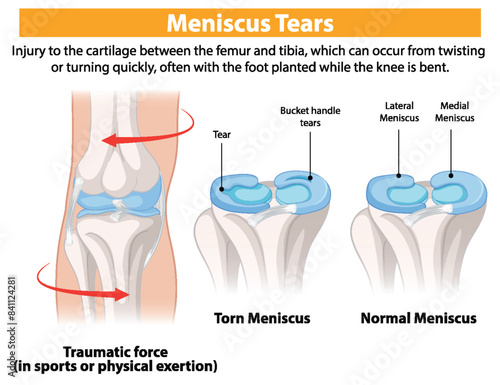 Illustration of normal and torn meniscus in knees