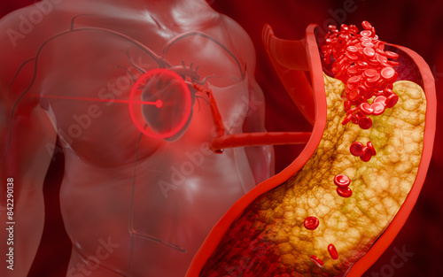 Hyperlipidemia or arteriosclerosis. Blocked artery concept and human blood vessel as a disease with cholesterol fat buildup clogging. Clogged arteries, Cholesterol plaque in the artery. 3D Rendering