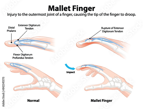 Diagram showing normal and mallet finger conditions