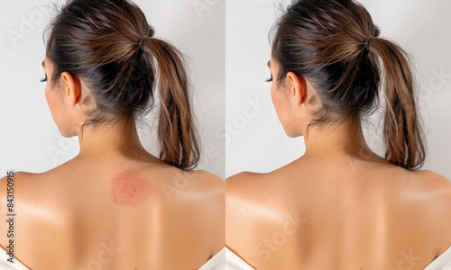 Treatment of eczema and scars. Before and after. A woman with scars on her back. Close-up. Laser treatment. Sensitive skin. Health insurance. Surgery. Beauty center