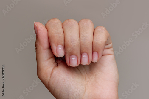 Close up of a woman's hand with white spots on the nails on a dark grey background. Vitamin deficiency, endocrine disorders, fungal bacterial infection, physical damage, stress, depression