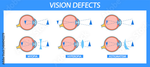 Informative Chart Detailing Myopia, Hyperopia, And Astigmatism In Eye Anatomy. Vector Visual Comparison