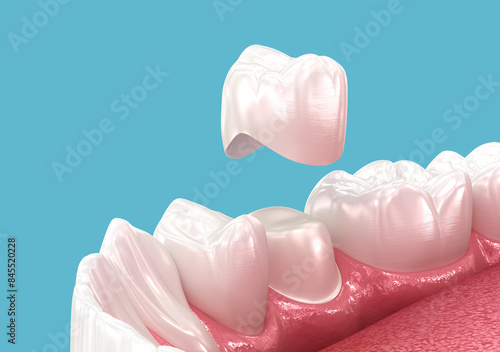 Dental crown placement over tooth. 3D illustration