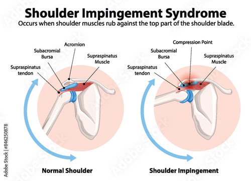 Comparison of normal shoulder and impingement