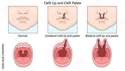 normal, unilateral cleft lip and palate, and bilateral cleft lip and palate conditions in infants diagram hand drawn schematic vector illustration. Medical science educational illustration