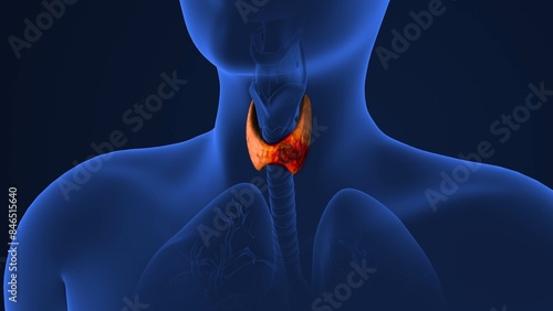 Tumor spread in the thyroid gland