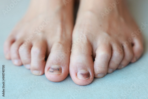 Subungual Hematoma on toenail are injuries of wearing shoes that are too tight in which bleeding develops under the nail. A crush injury to the distal phalanx fingernail or toenail, black toenail.