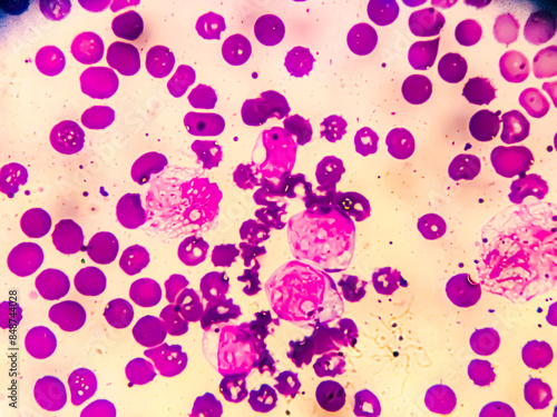 Chronic myeloid leukemia cells or CML, analyze by microscope. Blood cancer image.