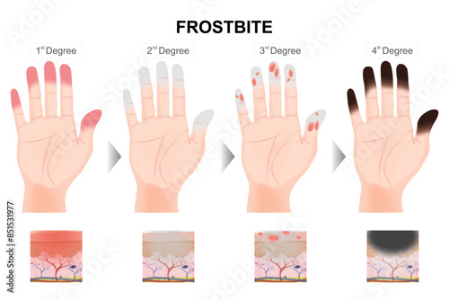 Frostbite 4-degree stages of hand illustration