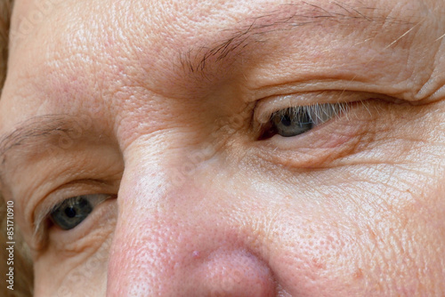 middle aged female's face with drooping eyelid eyes. Ptosis is a drooping of the upper eyelid, lazy eye, first wrinkles