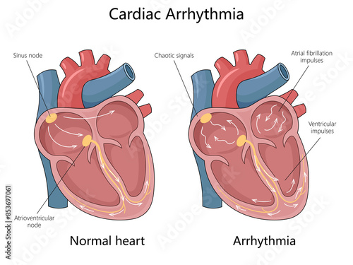 normal heart with cardiac arrhythmia, showing sinus node, chaotic signals, and atrial fibrillation diagram hand drawn schematic raster illustration. Medical science educational illustration