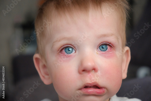 Red swollen eyes from conjunctivitis child, ill allergic eyes in babies. Close-up of a baby with conjunctivitis