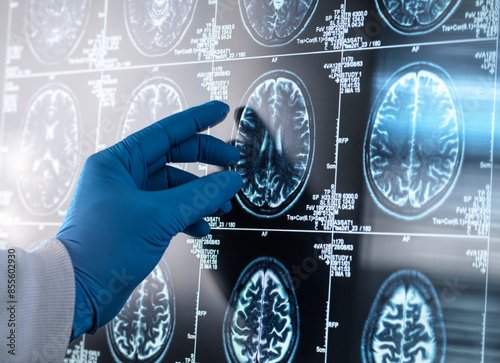 Neurology Research, Doctor viewing a patients MRI Scan for damage