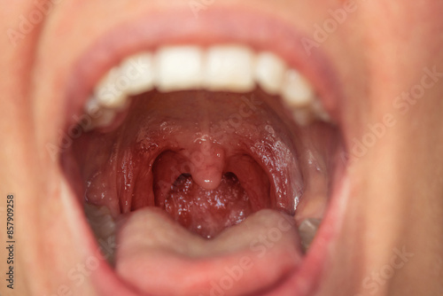 The woman suffers from pharyngitis. Red sore throat caused by infections and viruses, close-up photo. Tonsillitis, inflamed tonsils. Sore throat. ENT diseases