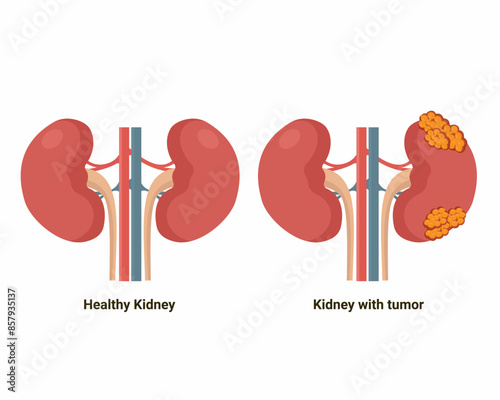 normal kidney and kidney with tumor Polycystic kidney disease Internal organs