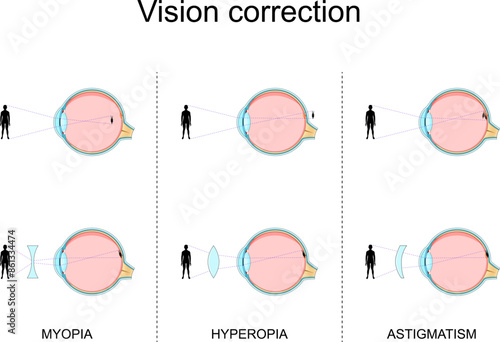 Vision defects. Myopia, Hyperopia, Astigmatism. Vision Correction